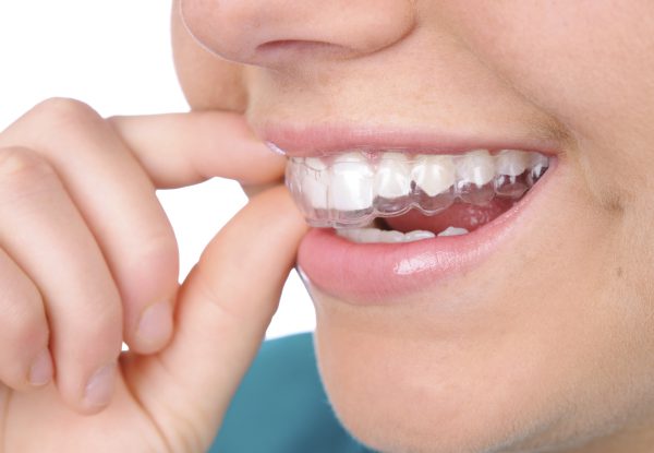 Niềng răng mắc cài sứ mang tính thẩm mĩ cao