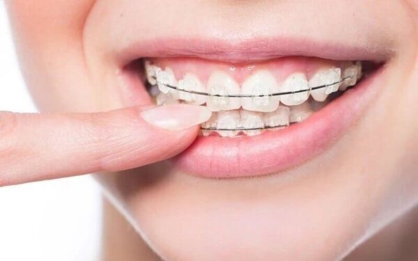 Phương pháp niềng răng mắc cài sứ