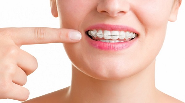 Trong thời gian niềng răng cần có chế độ chăm sóc răng miệng phù hợp
