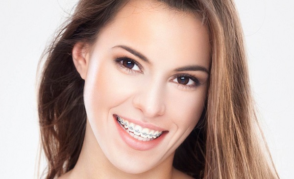 Niềng răng giúp bạn có nụ cười tự tin và thẩm mĩ hơn rất nhiều