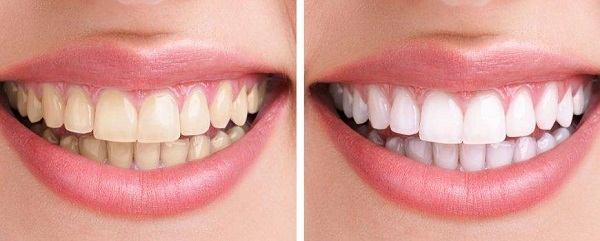 Tẩy trắng răng giúp bạn tự tin hơn với nụ cười trắng sáng của mình