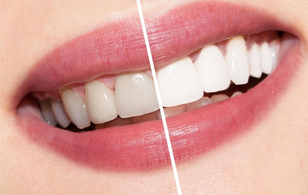 Tẩy trắng răng tại Nha Khoa Miền Tây- đảm bảo an toàn, hiệu quả và lấy lại sự tự tin cho nụ cười của bạn