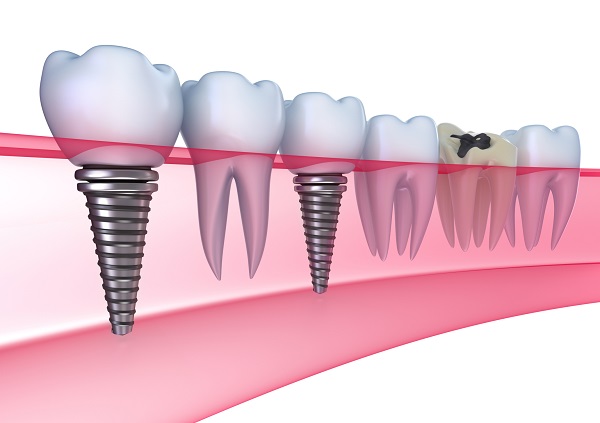 Dịch vụ trồng răng Implant ở Cần Thơ yêu cầu kĩ thuật và tay nghề của bác sĩ cao, chuyên nghiệp
