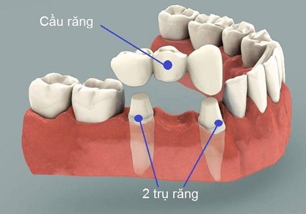 Tùy từng trường hợp mà nên cân nhắc lựa chọn trồng răng sứ hay không vì kết cấu và tình trạng răng của mỗi người là khác nhau