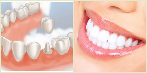 Trồng răng sứ đẹp cần có quy trình thực hiện đúng chuẩn và an toàn