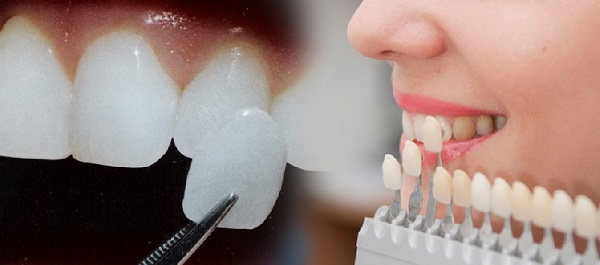 Trồng răng sứ Veneer mang lại hiệu quả thẩm mĩ cao