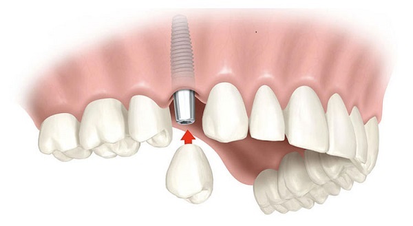 cấy ghép implant răng cửa