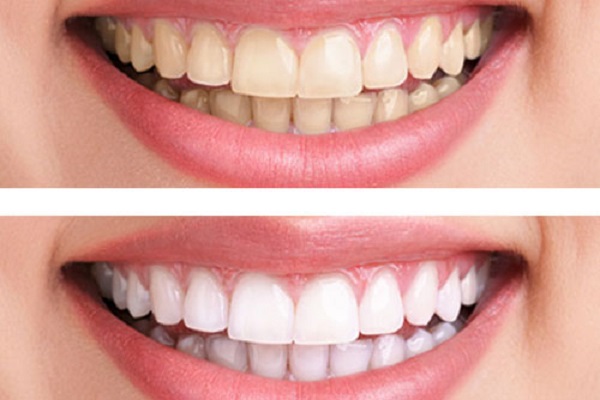 Cách tẩy răng trắng sáng chỉ trong 1h đồng hồ | Nha Khoa Miền Tây