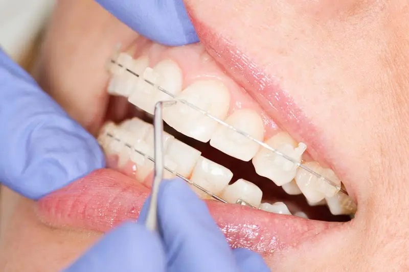 Hình ảnh chi tiết về mắc cài sự tự buộc