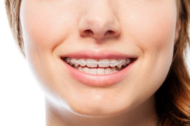 mắc cài sự tự buộc