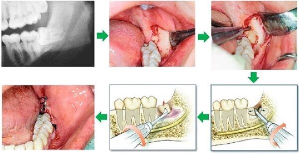 Vì sao nên nhổ răng tiểu phẫu bằng máy Piezotome