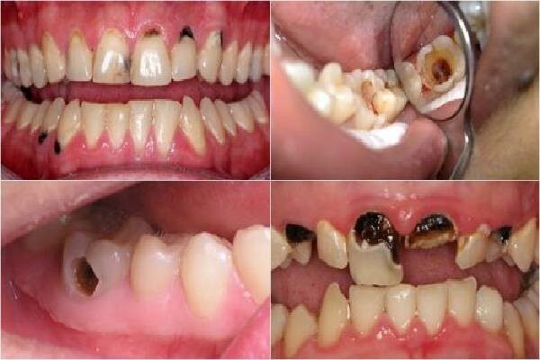 Các trường hợp cần phải phục hồi răng