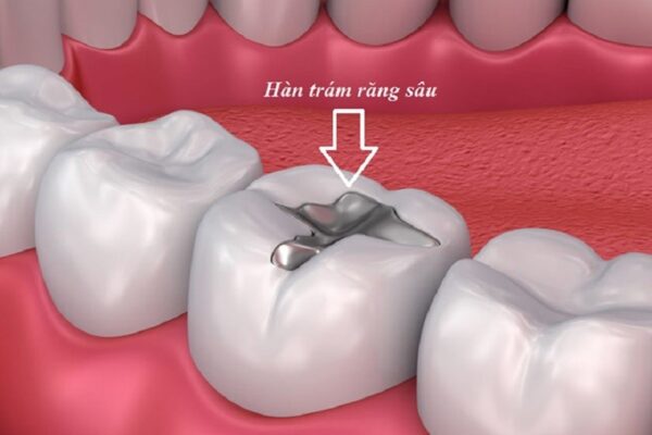 Hàn trám là phương pháp phục hồi răng