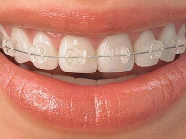 Hiệu quả thẩm mỹ của dây cung niềng răng là gì