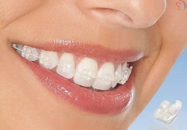 Lợi ích khi niêng răng bằng mắc cài sứ dây thun