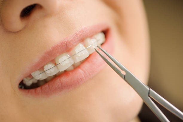 mắc cài sự tự buộc dễ dàng vệ sinh