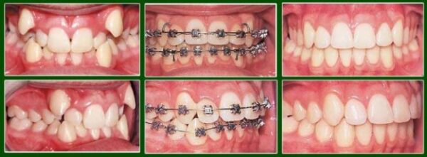 Tác dụng của dây cung niềng răng