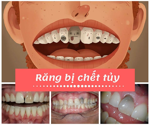 khi nao can chua tuy rang