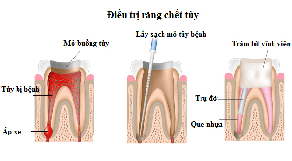 cac buoc dieu tri tuy rang