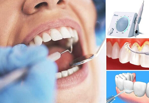 Phương pháp làm sạch răng bằng công nghệ tiên tiến