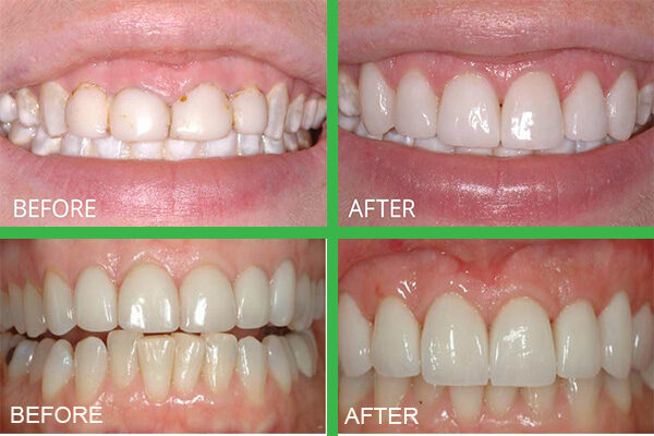 Hiệu quả của phương pháp phẫu thuật kéo dài thân răng