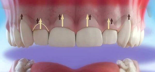 Làm dài thân răng bằng cách cắt bỏ phần nướu 