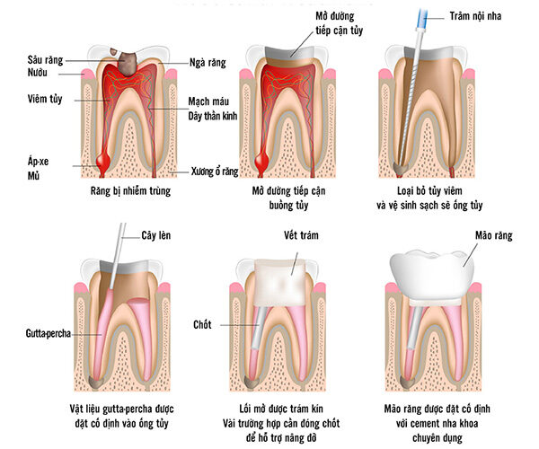 Quy trình điều trị nội nha
