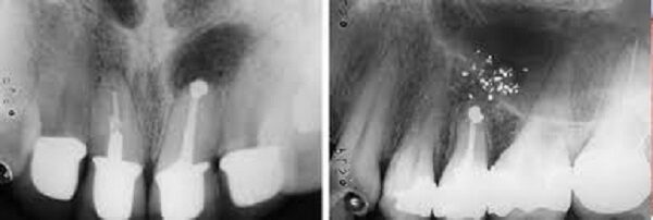 Quy trình thực hiện phẫu thuật cắt chóp răng