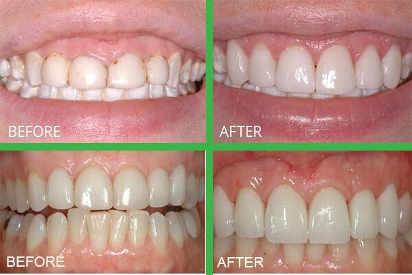 Phương pháp phẫu thuật kéo dài thân răng giúp cải thiện tính thẩm mỹ cho hàm răng, mang lại nụ cười tự tin khi giao tiếp với người đối diện