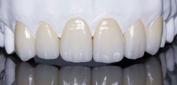 Răng sứ Zirconia là gì?