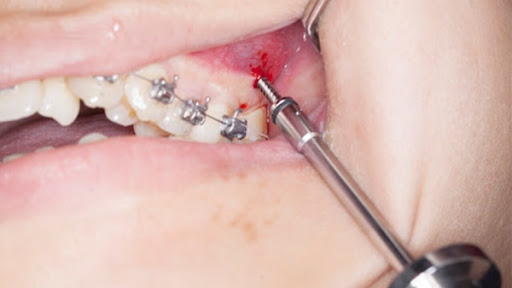 Vít niềng răng là tiến bộ trong chỉnh nha