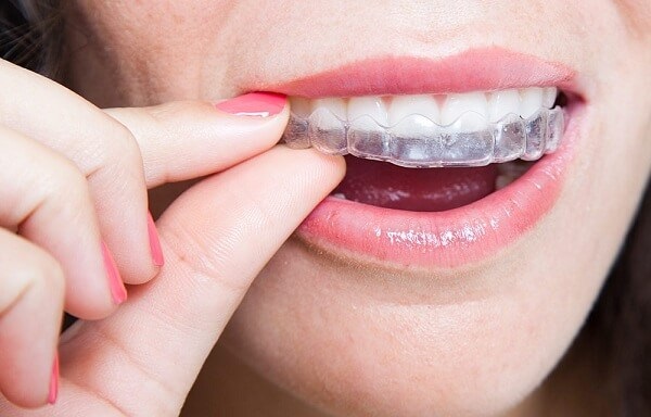 Niềng răng thẩm mỹ tại Cần Thơ có hỗ trợ trả góp, không lãi suất