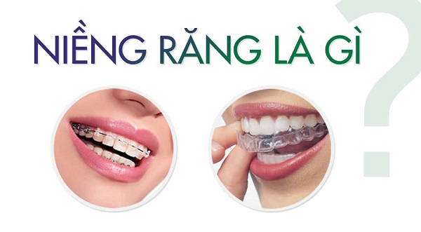 Tìm hiểu những vấn đề xung quanh việc niềng răng