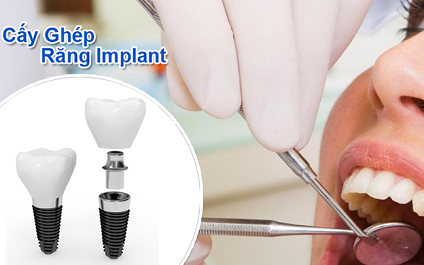 Trồng răng Implant ở Cần Thơ