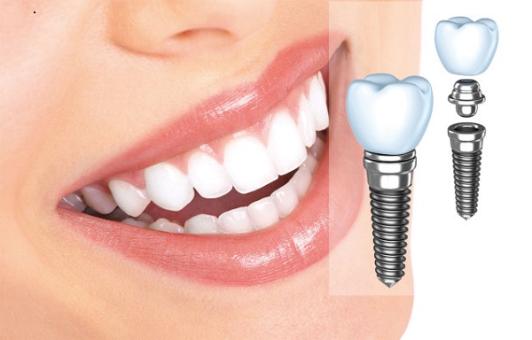 Trồng răng Implant ở Cần Thơ