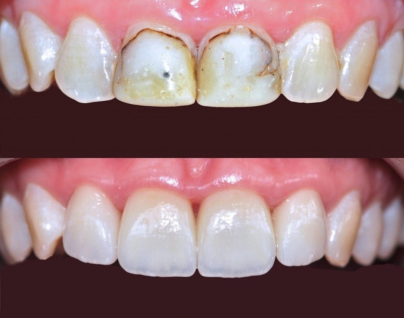 Mòn cổ răng cần phải phục hồi răng