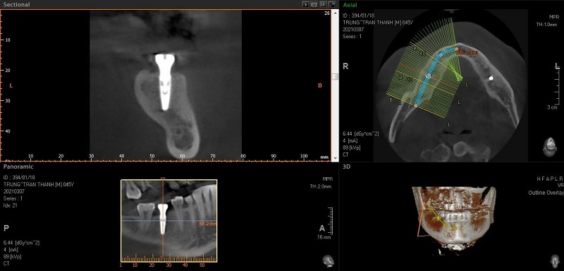Quá trình tiến hành cấy ghép răng implant