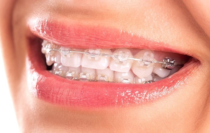 Tính thẩm mỹ của dây cung niềng răng