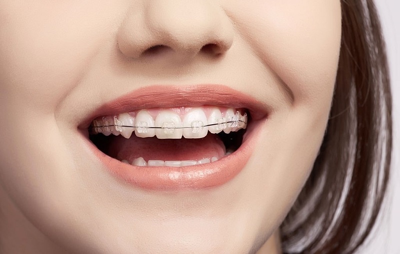 Ưu điểm của mắc cài sự tự buộc