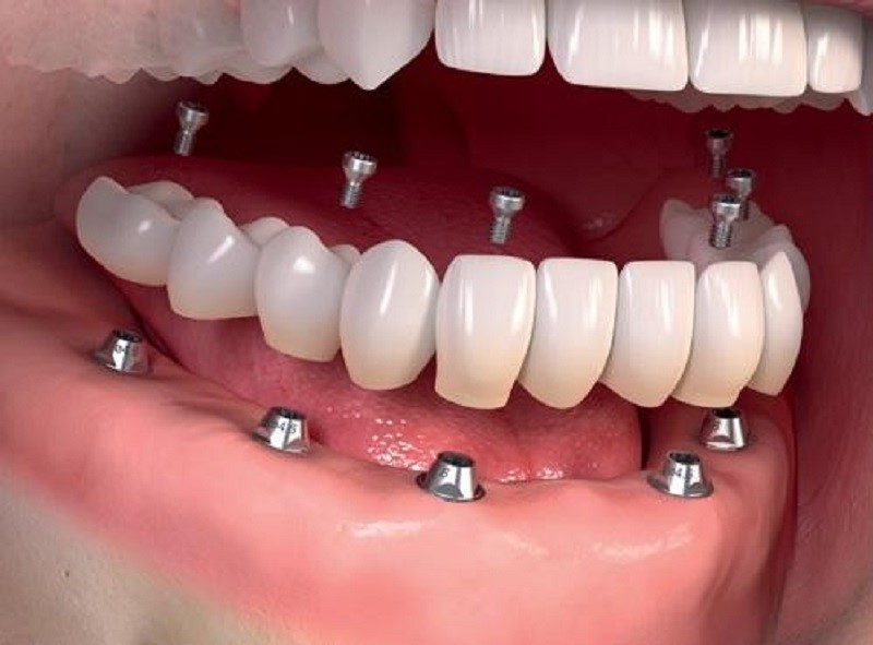 Implant nửa hàm dưới