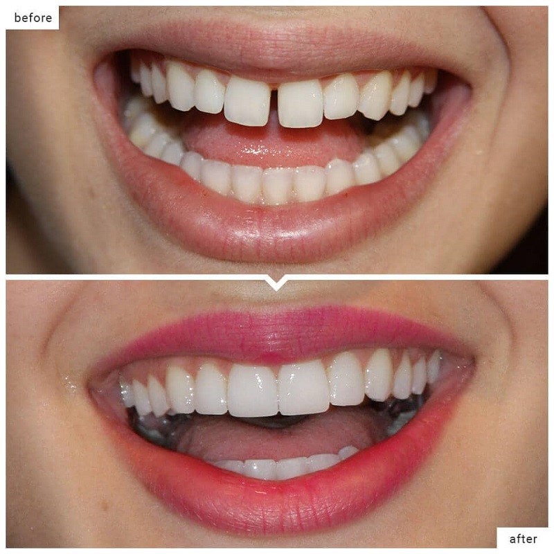 Trước và sau khi gắn răng sứ Zolid HT