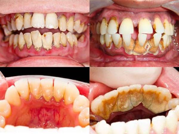 Mảng bám tích tụ lâu ngày sẽ hình thành cao răng, ảnh hưởng đến sức khỏe răng miệng