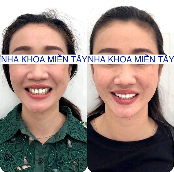 Có nên bọc răng sứ Zirconia hay không?