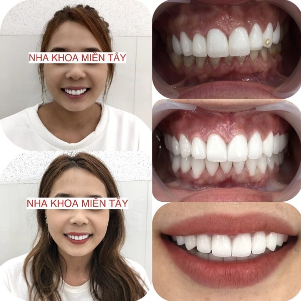 Răng sứ 3m Lava Plus và những điều bạn chưa biết