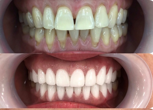 Răng sứ Zirconia và những điều cần biết