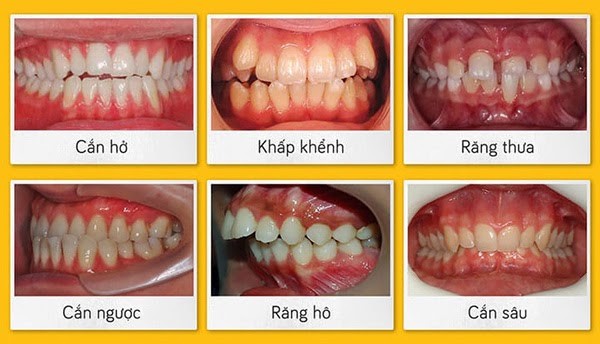Niềng răng Invisalign - Kỹ thuật niềng răng trong suốt không mắc cài