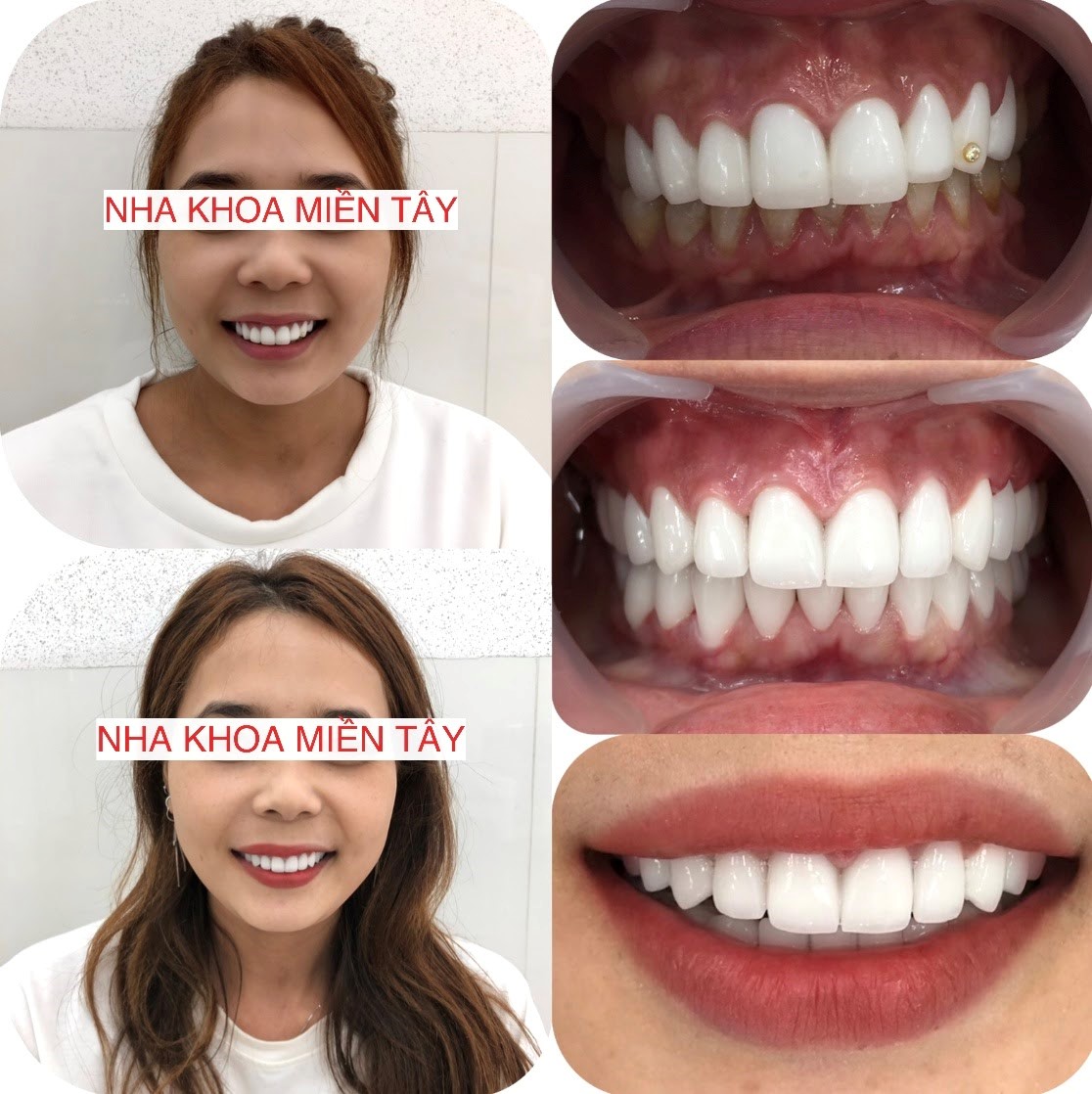 Răng sứ Lava Plus có bền không? Bọc răng sứ Lava Plus giá bao nhiêu?