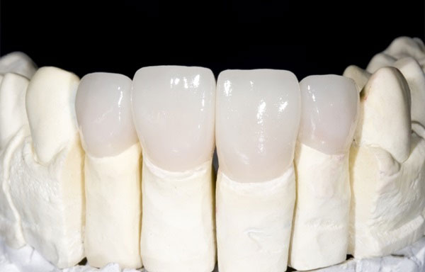Phương pháp bọc răng sứ là gì?