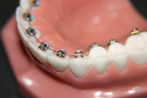 Có nên niềng răng mắc cài lưỡi không?