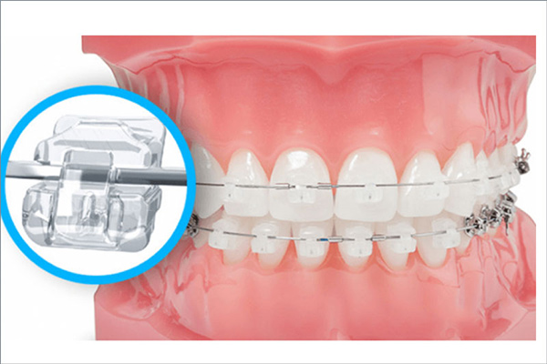 Những điều cần biết về mắc cài sứ dành cho người mới sử dụng